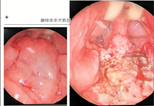 腺样体手术过程图图片